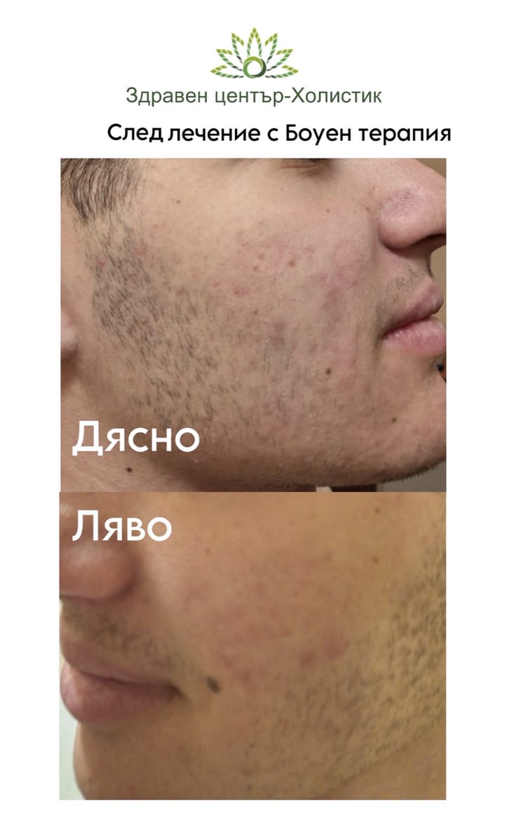 Хормонално акне – след лечение с Боуен терапия