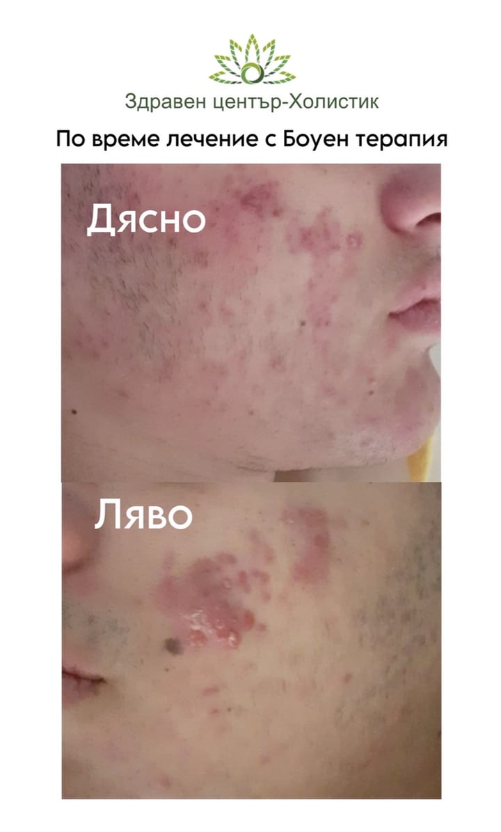 Хормонално акне – по време на лечение с Боуен терапия