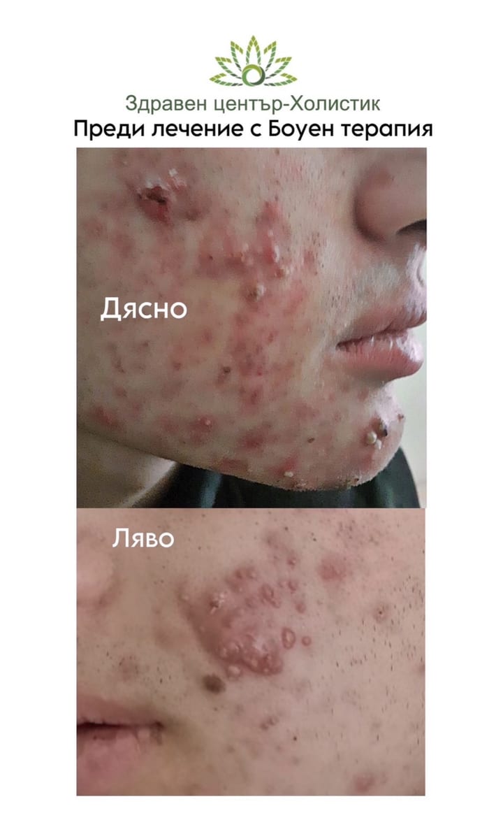 Хормонално акне – преди лечение с Боуен терапия