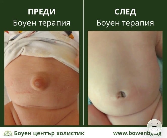 Пъпна херния – документ